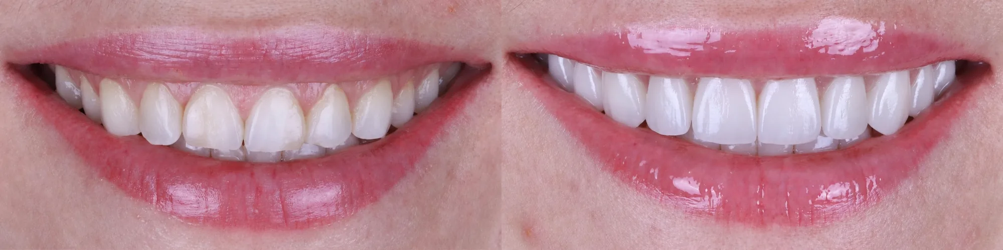 Carillas dentales en Gandia: Cambio de color y luminosidad: de una sonrisa apagada a un blanco natural y uniforme.